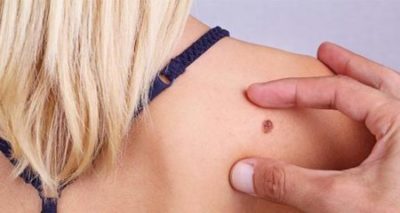 20 квітня – Всеукраїнський день боротьби з меланомою